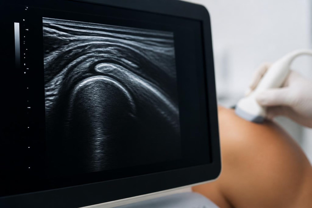 Foto 1 Elimine el dolor con lavado ecoguiado para tendinitis cálcica de hombro en Pontevedra