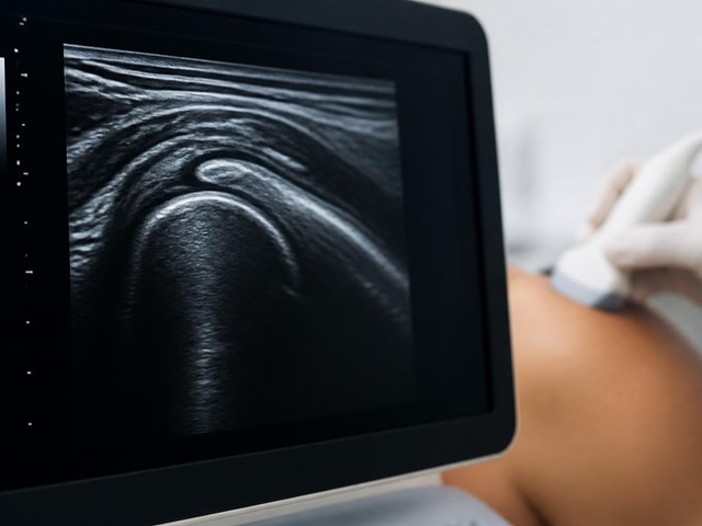 Elimine el dolor con lavado ecoguiado para tendinitis cálcica de hombro en Pontevedra