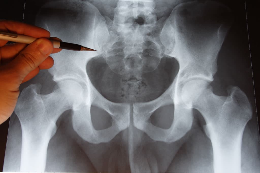 Tratamiento para dolencias de cadera en Pontevedra